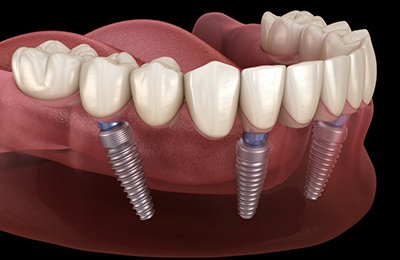 diagram of dental implants supporting a full denture on bottom arch 