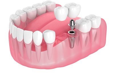 Implant-Retained Bridge | Missing Teeth Brownstown | Dr. Sammi Hadad